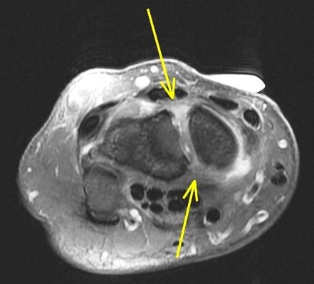 Figure 5 for case scapholunate ligament tear ( RID2259 )